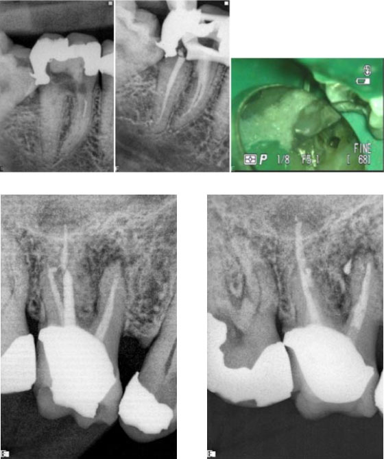 clinical-cases-endo61-3-Removal-of-Canal-Blockages Removal of Canal Blockages