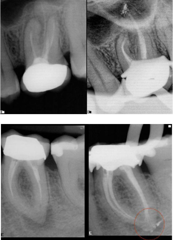 clinical-cases-endo61-4a-Re-treatments Re-treatments