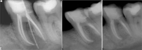 clinical-cases-endo61-4b-Re-treatments Re-treatments
