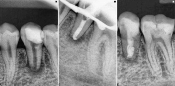 clinical-cases-endo61-5-Immediate-apexification Immediate apexification