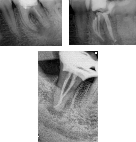 Immediate apexification unusual cases