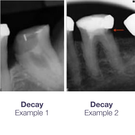 Decay examples on Endo61 X-Rays