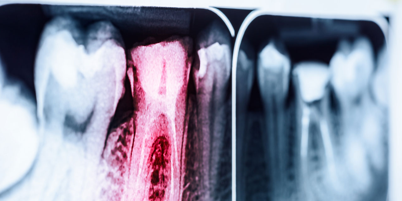 slider-gallery8 X-rays Endo61
