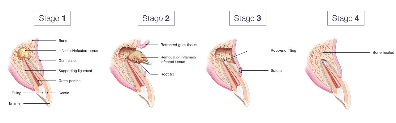 About Microsurgery Endo 61